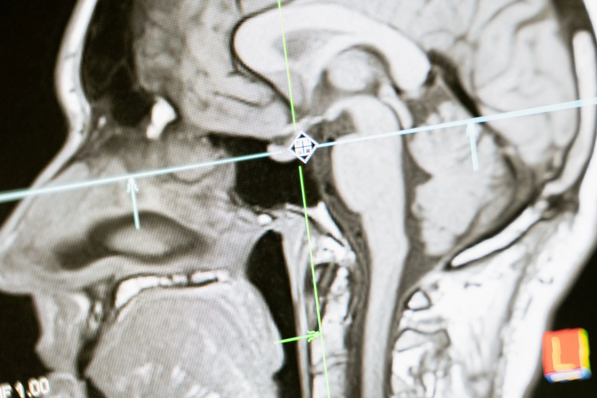 A close-up of a brain MRI image displayed on a screen.